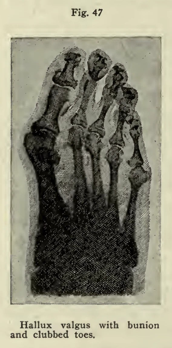 Vintage X-ray of a foot, Fig. 47, showing hallux valgus with a bunion and clubbed toes